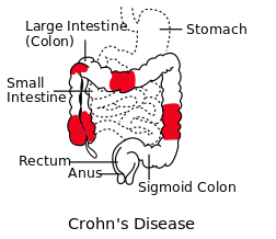 how crohns disease affects different areas of the stomach depending on the person.