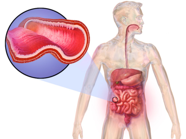 how chrons disease affects the intestines